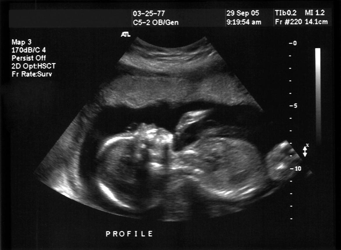 Ultrasound reading tissue depth under the contact ring